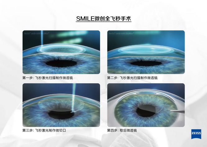 高考后在重庆做近视手术，如何选择手术方式？重庆近视手术专家汪红来揭秘！