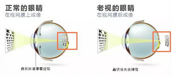 慈航医疗：刚过40岁看近就不行了吗？中老年人的老视问题光学矫正这样做！